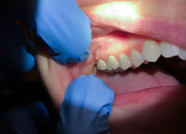 Best Emergency Dentist for Lost Fillings or Crowns in New London, IA